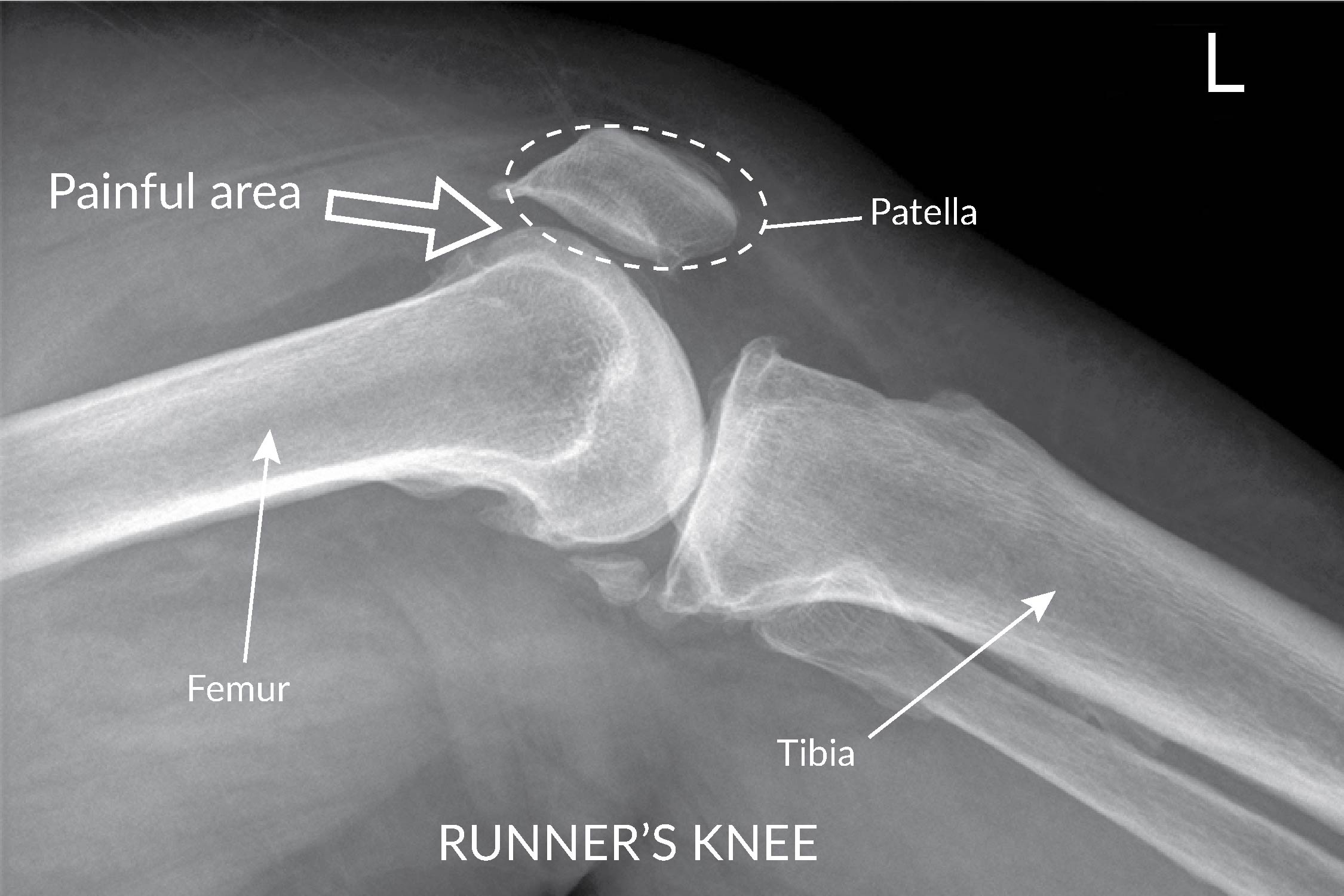 knee pain after running