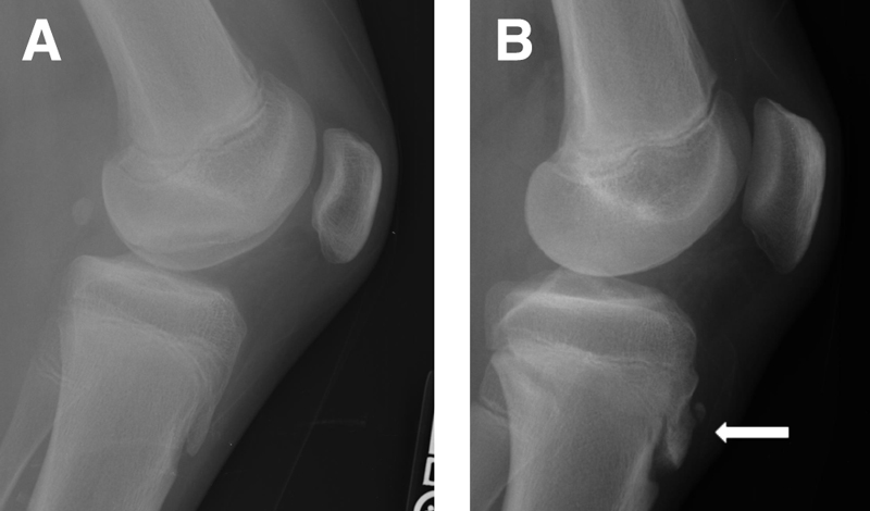 tibial tubercle pain