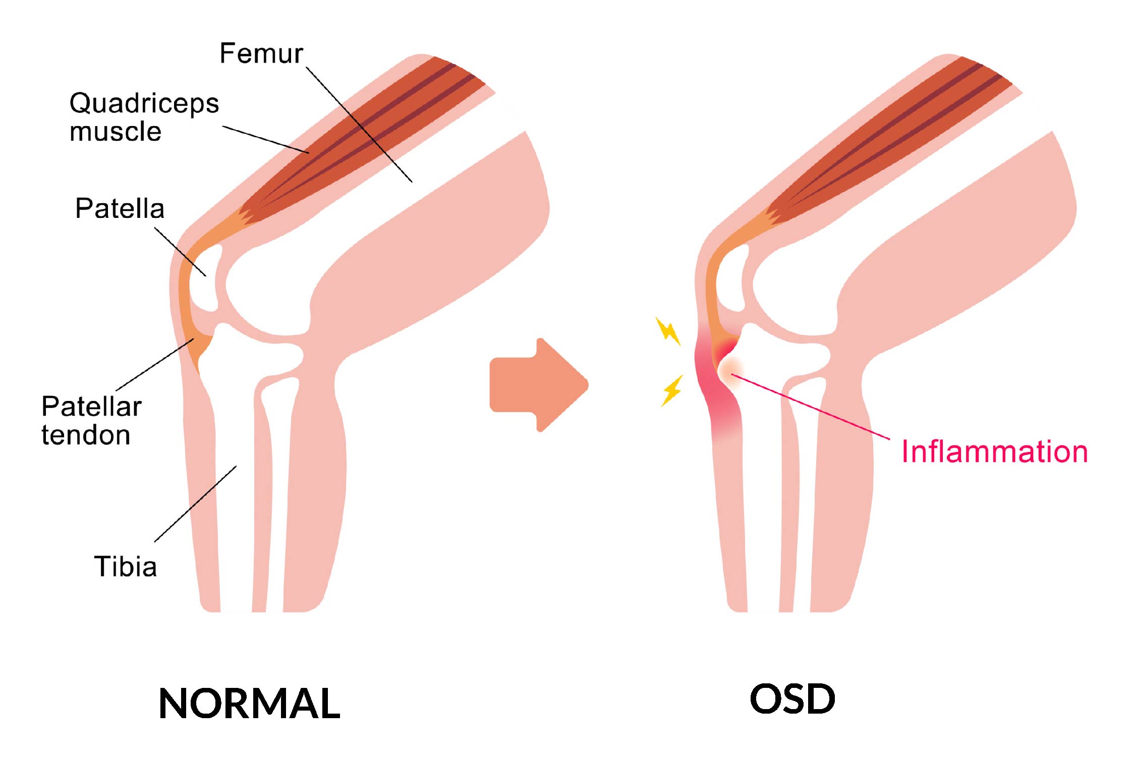 Osgood Schlatter Disease