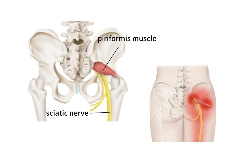 how to sit with piriformis syndrome