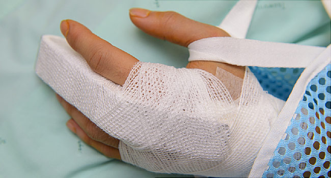 broken versus sprained finger